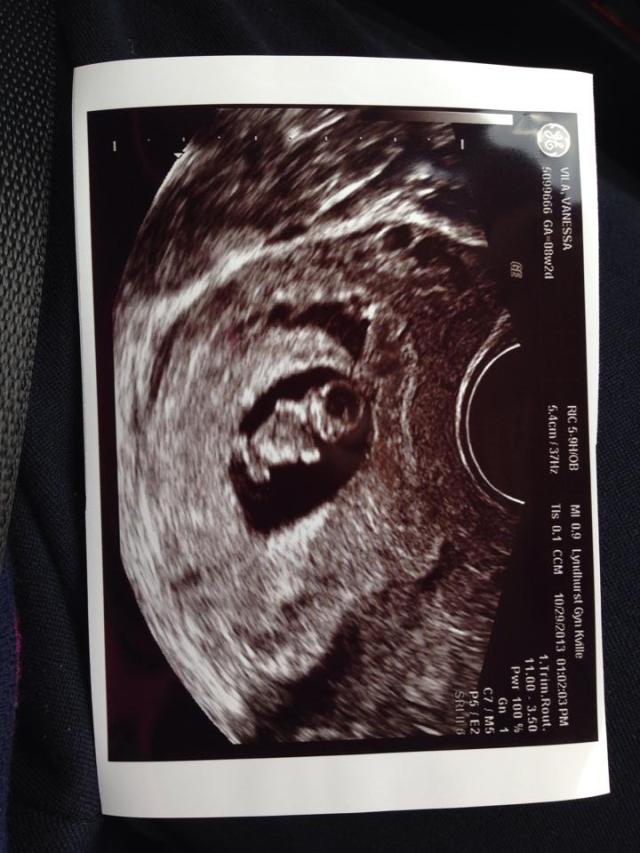 ultrasound 8 weeks baby2